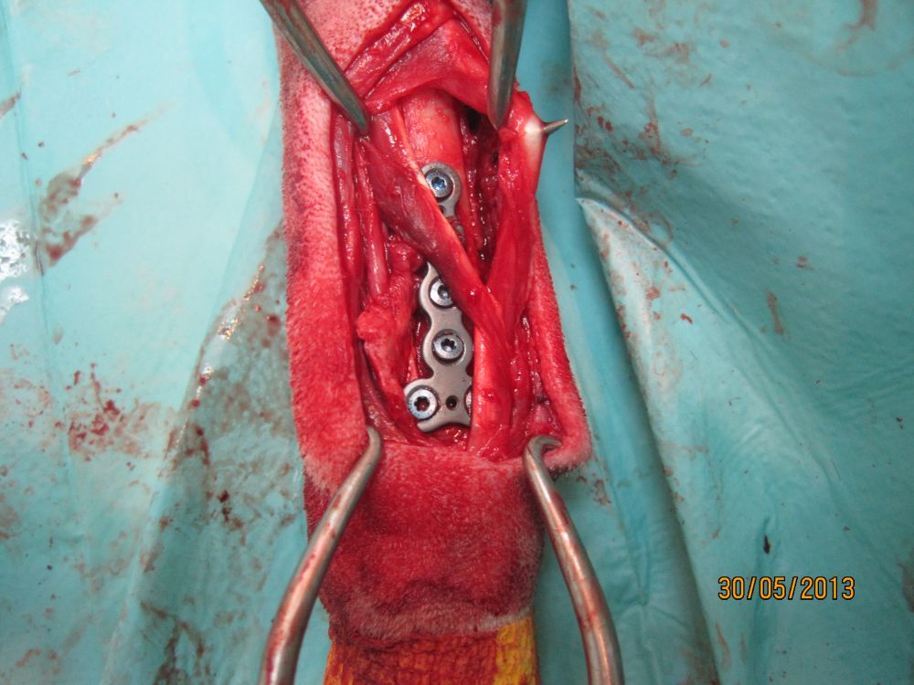 fractura distal 2