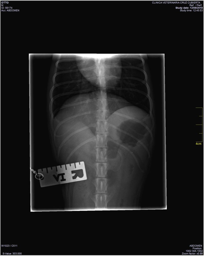 radiografia obstruccion intestinal 
